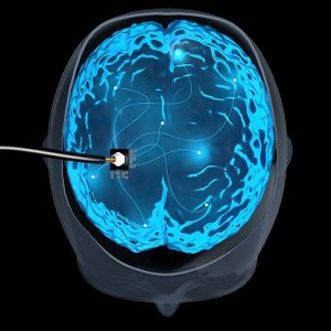 The Potential Impact of Electrode Implants on Stroke Survivors 